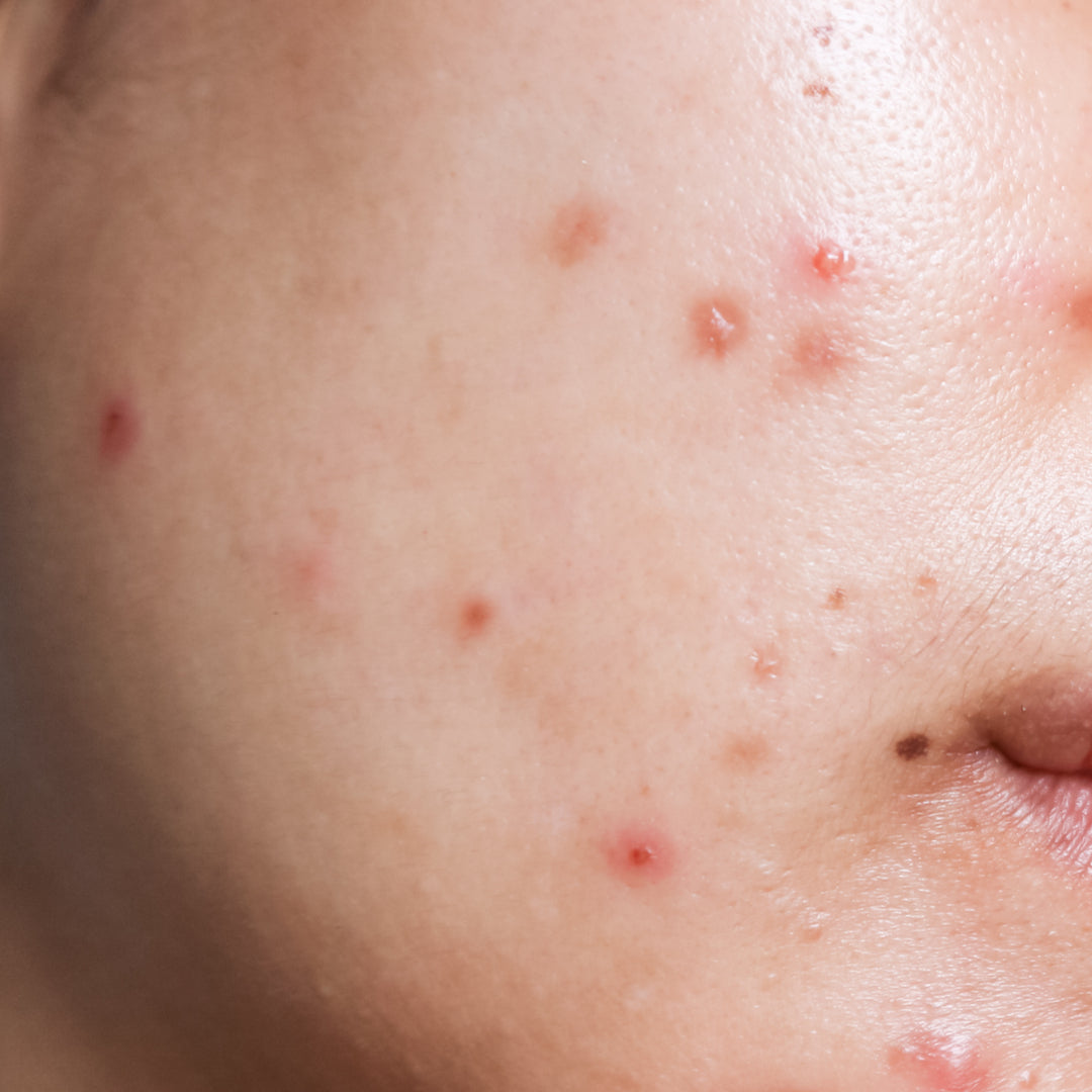 acne prone skin