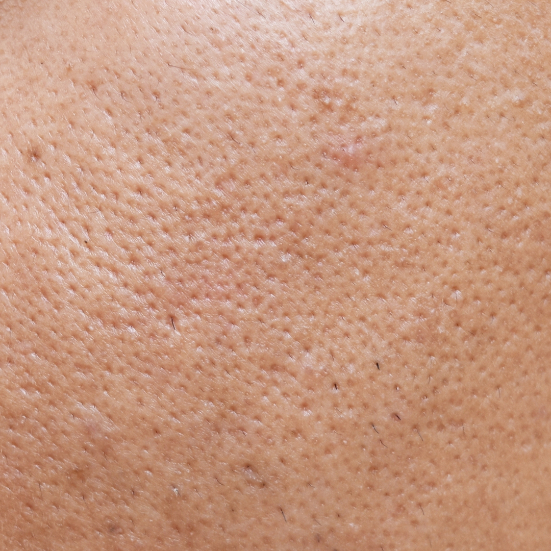 large pores